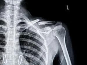 Image for Broken Bone Injury Lawyer in Scottsdale