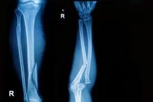 Image for Broken Bone Injury Lawyer in Phoenix