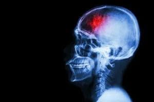 Image for Brain Injury Lawyer in Tucson