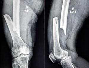 Image for Broken Bone Injury Lawyer in Tucson