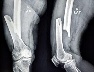 X-Ray showing broken bone